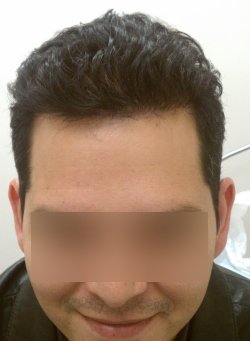 New Hair Growth