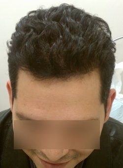 New Hair Growth