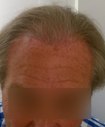 After hair transplant