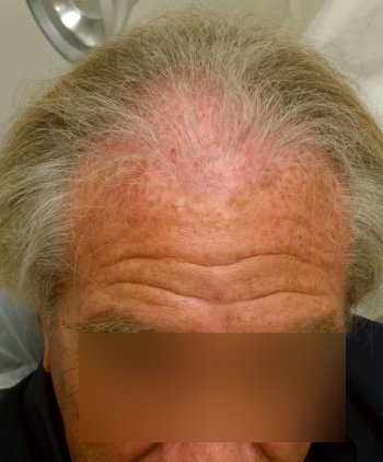 Before hair transplant