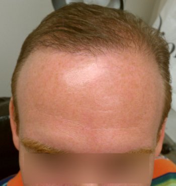 Hair Transplant & AFR
