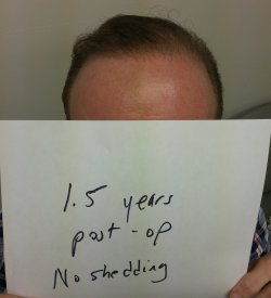 Hair Transplant & AFR
