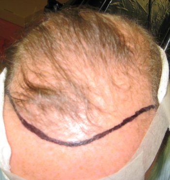 Before hair transplant