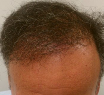 Hair Transplant & AFR