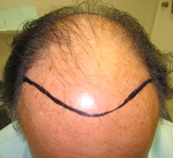 Before hair transplant