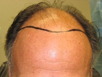 Before hair transplant