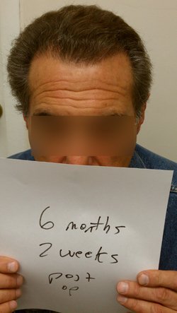 after 2nd hair transplant