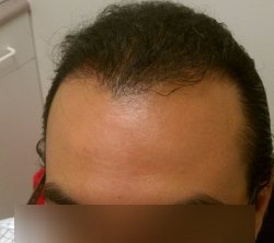 Hair Transplant & AFR