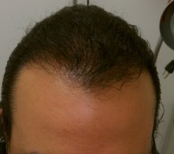 Hair Transplant & AFR