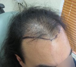 Before hair transplant