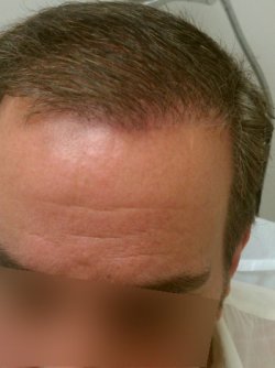 Hair Transplant & AFR