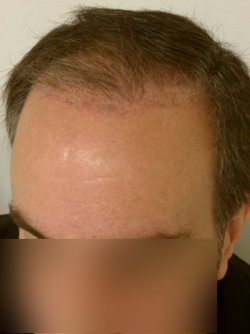Before hair transplant