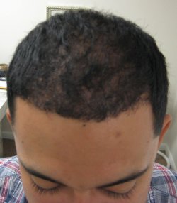 After hair transplant