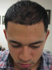Hair Transplant & AFR