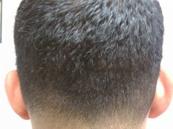 Hair Transplant no scar