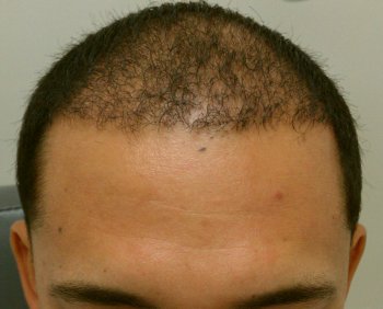 Hair Transplant & AFR