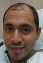 Before hair transplant