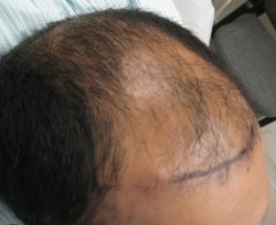 Before hair transplant