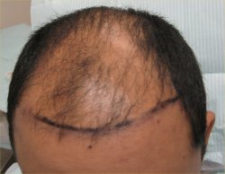 Before hair transplant