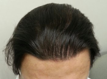 after Hair Transplant