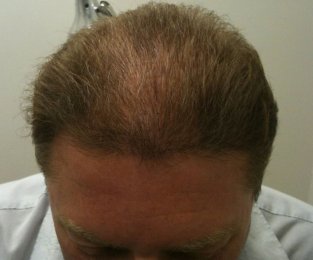 New Hair Growth