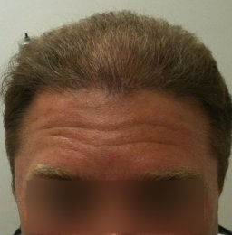New Hair Growth