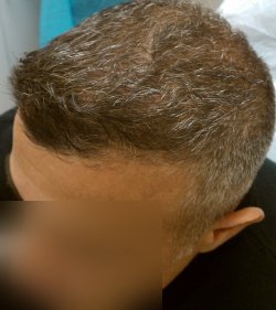 After follicle Growth