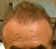 After follicle Growth