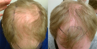 Identical twins with male pattern balding. One took anabolics.