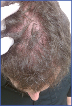 hair loss from creatine