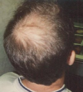 Genetic hair loss