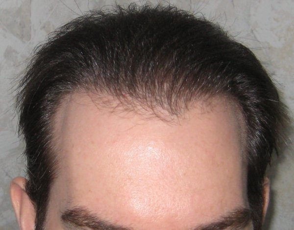 Hair Transplant & Hair Restoration