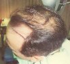 Male, 40s, hair transplant photo