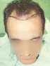 Men, hair transplant photo, 40 years old