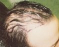 Male hair transplants pic, age 28