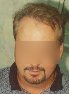 After hair transplants pic, mid-life, male