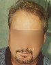 After hair transplants pic, mid-life, male