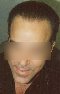 Male, age 30 hair transplant photo