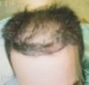 Male, age 40 hair transplant photo