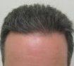 Male, age 40, hair transplant after