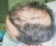 Male, age 40, before hair transplant