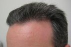 Male, age 40, after hair transplant
