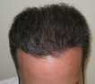 Male, age 40, after hair transplant