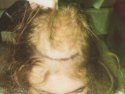 Man, hair transplant photo, age 18