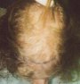 Man, hair transplant photo, age 18