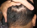 hair restoration after image