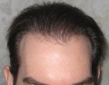 hair restoration after image
